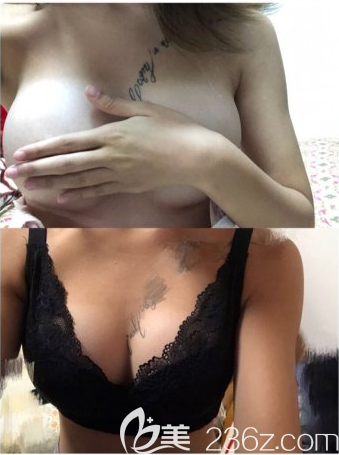 韓國PJS樸真奭隆胸真人案例 韓國PJS樸真奭隆胸真人案例