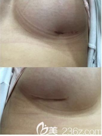 乳腺下切口 乳腺下切口