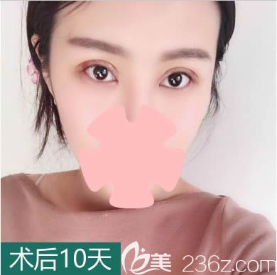 在長春中妍整形做雙眼皮10天后照