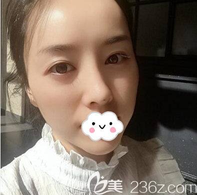 石曉軍玻尿酸填充全臉第5天恢復(fù)照片 石曉軍玻尿酸填充全臉第5天恢復(fù)照片