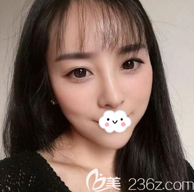 前段時(shí)間做活動(dòng)，我當(dāng)成都美極模特找石曉軍做的全臉玻尿酸填充加線雕隆鼻效果圖