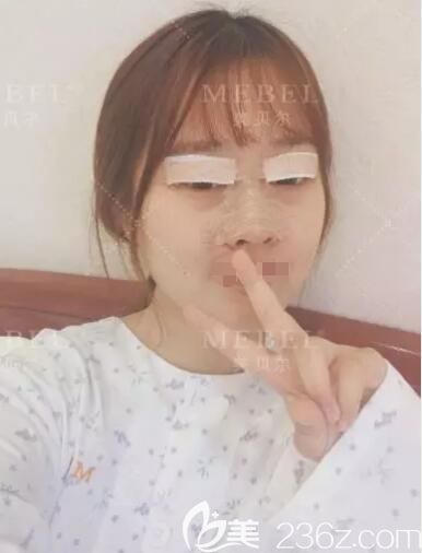 剛做完眼鼻整形術后即刻效果 剛做完眼鼻整形術后即刻效果