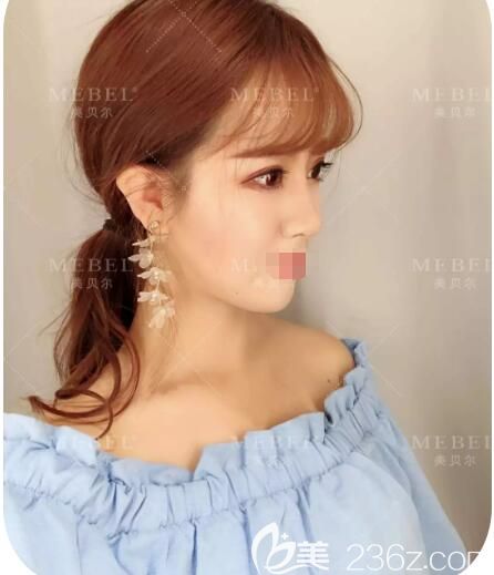 擔(dān)心去眼袋恢復(fù)慢會(huì)反彈?揚(yáng)州美貝爾真人體驗(yàn)分享祛眼袋為首的眼綜合+鼻綜合前后10天蛻變心路歷程