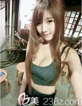 魯天宇自體脂肪豐胸術(shù)后19天 魯天宇自體脂肪豐胸術(shù)后19天