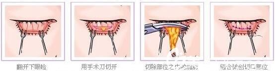 內(nèi)切去眼袋適合那些人