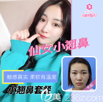 異體軟骨隆鼻案例