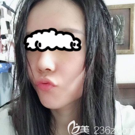 講述我在做硅膠+耳軟骨隆鼻的真實(shí)感受，并附鼻綜合術(shù)后1-7天的照片