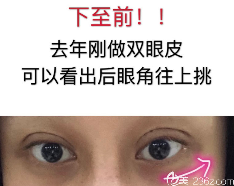 眼角下<span style= 眼角下<span style=