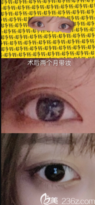 術(shù)后2個(gè)月眼角下<span style= 術(shù)后2個(gè)月眼角下<span style=