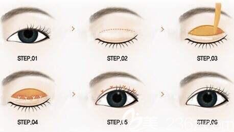 全切雙眼皮過(guò)程示意圖