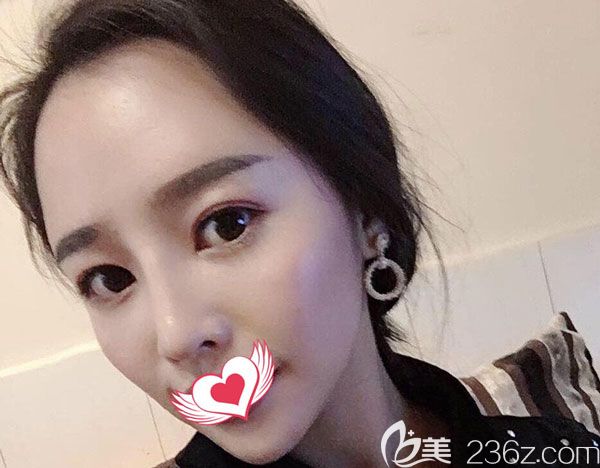 耳軟骨隆鼻第20天看著很自然