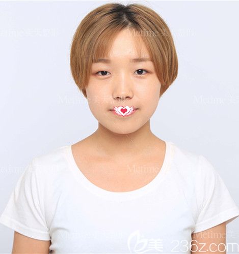 在承德美天做眼綜合術前是單眼皮腫泡眼 在承德美天做眼綜合術前是單眼皮腫泡眼