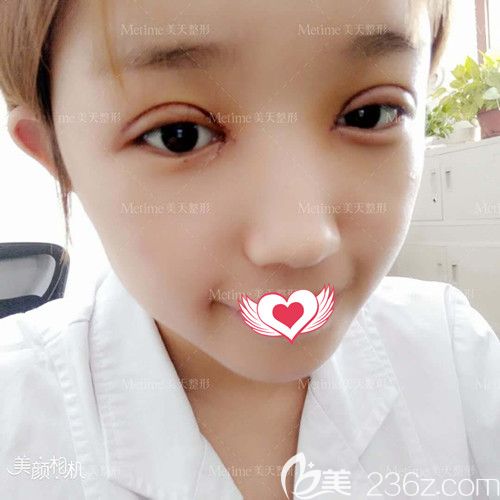 美天整形醫(yī)生郭東超為我做眼綜合術后眼睛腫脹 美天整形醫(yī)生郭東超為我做眼綜合術后眼睛腫脹