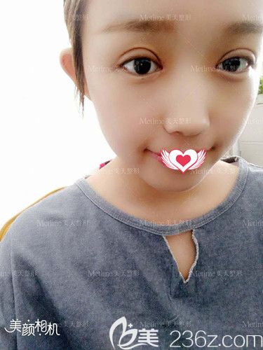 郭東超為我做眼綜合術后7天雙眼皮和眼角進行拆線 郭東超為我做眼綜合術后7天雙眼皮和眼角進行拆線