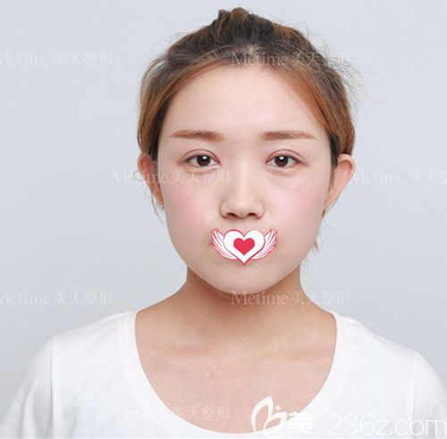 眼綜合整形術(shù)前我是路人甲 在承德美天做完切開雙眼皮和開眼角后瞬變大眼美萌少女