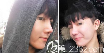 在韓國本愛醫(yī)院做了鼻綜合手術(shù)后3個(gè)月就告別了我的大鼻頭