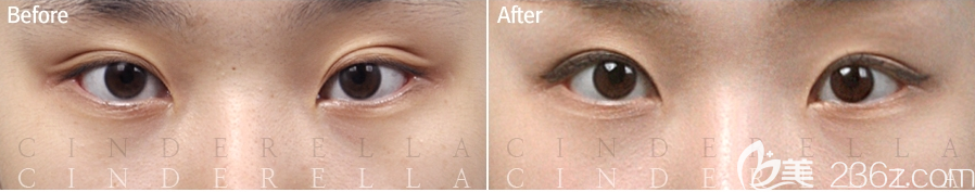 韓國灰姑娘整形鄭鐘必雙眼皮修復(fù)案例效果對比圖