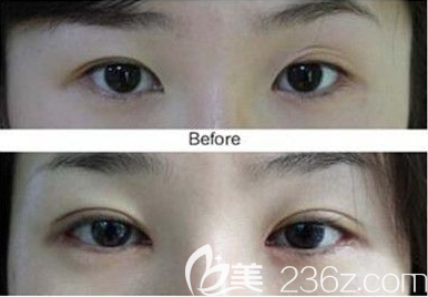 成鎮(zhèn)魔雙眼皮修復(fù)案例效果對比圖