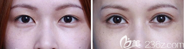 惠州伊麗莎白金鴻醫(yī)生雙眼皮手術(shù)案例 惠州伊麗莎白金鴻醫(yī)生雙眼皮手術(shù)案例