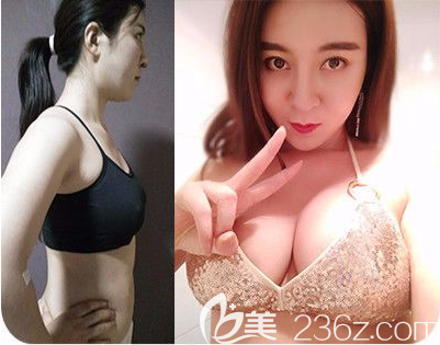 惠州伊麗莎白金鴻院長(zhǎng)做的隆胸案例 惠州伊麗莎白金鴻院長(zhǎng)做的隆胸案例