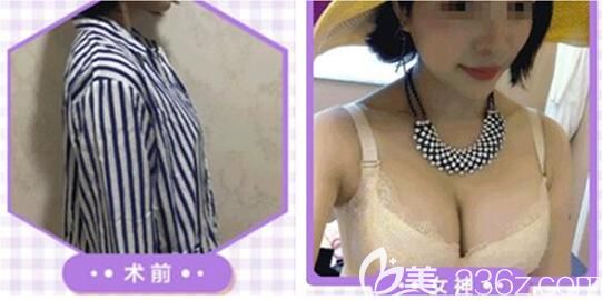 遵義利美康假體豐胸案例