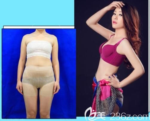 遵義利美康吸脂怎么樣