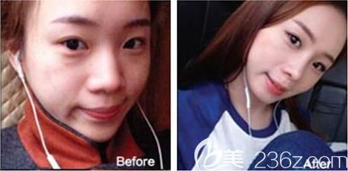 遵義利美康隆鼻好不好