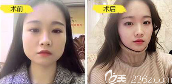 遵義利美康黃磊兵瘦臉案例 遵義利美康黃磊兵瘦臉案例