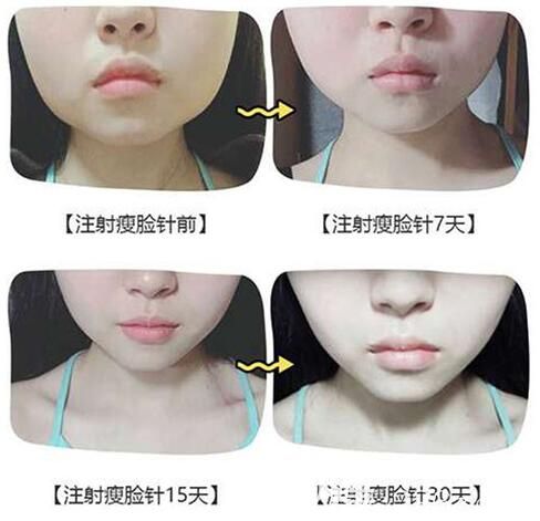 遵義利美康龍文萍瘦臉案例 遵義利美康龍文萍瘦臉案例