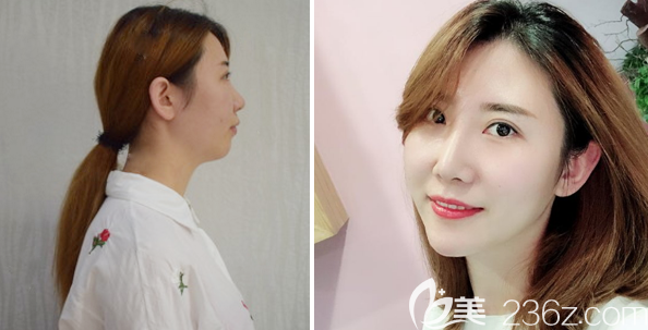 東莞韓美王仁斌醫(yī)生做的隆鼻和豐下巴手術(shù)案例 東莞韓美王仁斌醫(yī)生做的隆鼻和豐下巴手術(shù)案例