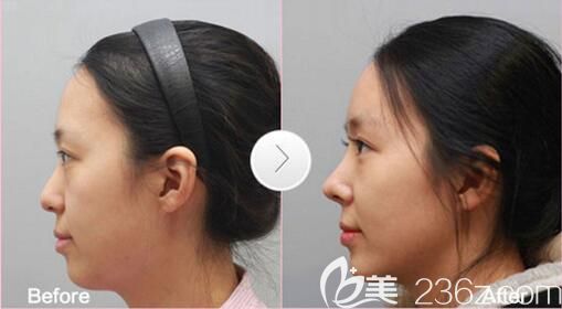 遵義利美康哪個(gè)醫(yī)生隆鼻好 遵義利美康哪個(gè)醫(yī)生隆鼻好