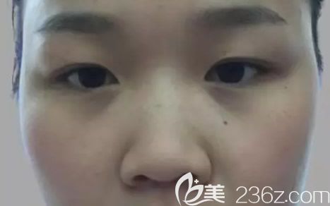 呼和浩華美整形美容綜合隆鼻前 呼和浩華美整形美容綜合隆鼻前