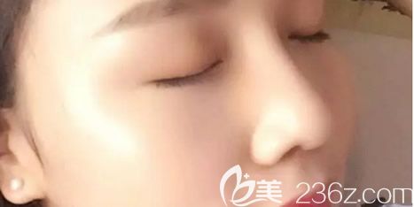 案例記錄：我找呼和浩特華美整形醫(yī)院做假體隆鼻和自體耳軟骨隆鼻手術(shù)的價(jià)格是12800元 