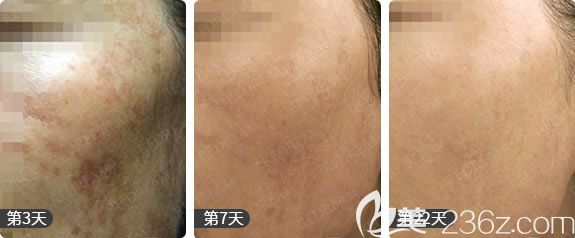 杭州薇琳陳丹激光祛黃褐斑<span style=