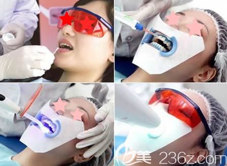 泉州維樂口腔王燕燕醫(yī)生牙齒美白過程圖 泉州維樂口腔王燕燕醫(yī)生牙齒美白過程圖