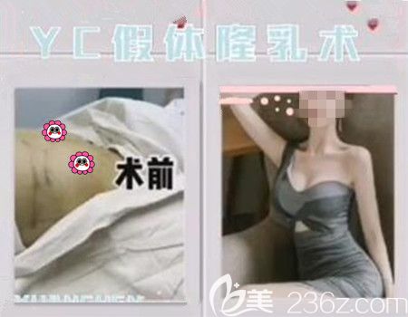 沈陽元辰假體豐胸真人前后效果對比圖