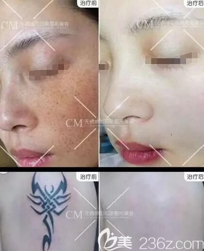 無錫坤如瑪麗皮秒效果對比案例