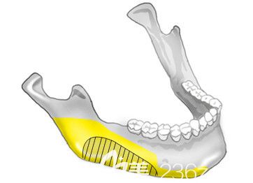長曲線修身下顎體縮小 長曲線修身下顎體縮小