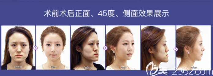 face-line整形醫(yī)輪廓案例 face-line整形醫(yī)輪廓案例