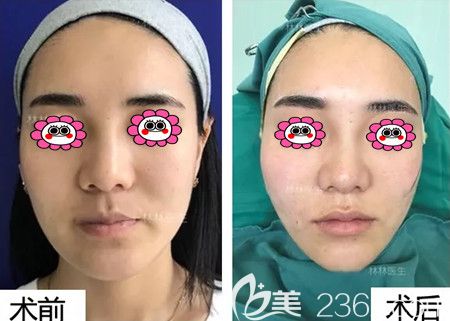 全臉線雕前后對比照片