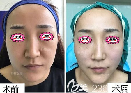 線雕前后效果圖