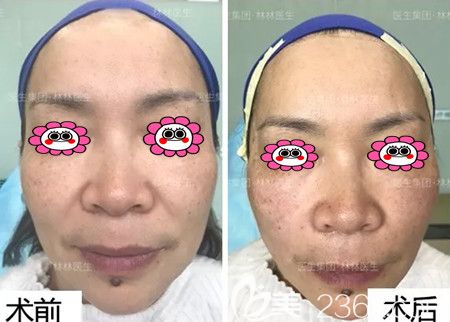 埋線提升變化圖