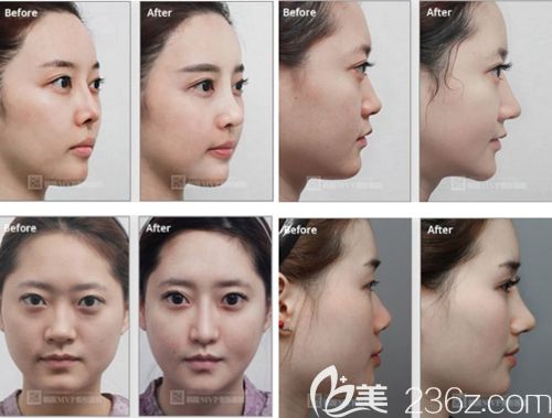 崔寓植院長隆鼻手術(shù)案例 崔寓植院長隆鼻手術(shù)案例