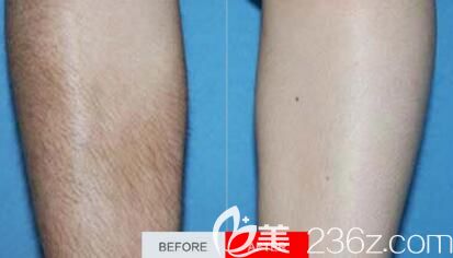 沈陽(yáng)元辰醫(yī)美冰點(diǎn)脫腿毛前后效果對(duì)比圖