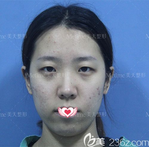 在承德美天做眼綜合術(shù)前是無(wú)神單眼皮 在承德美天做眼綜合術(shù)前是無(wú)神單眼皮