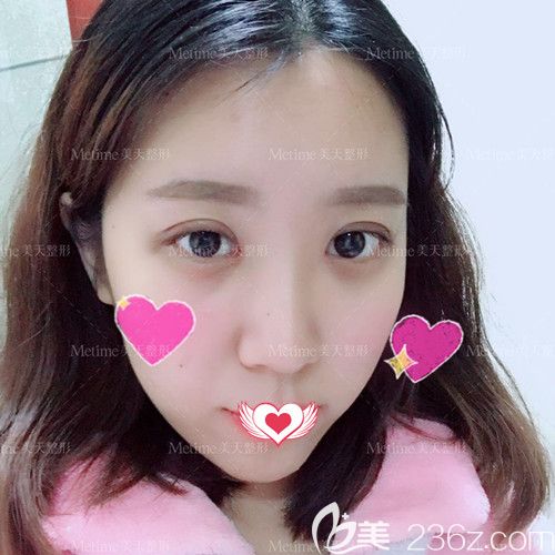 在承德美天做眼綜合術(shù)后20天雙眼皮消腫不少 在承德美天做眼綜合術(shù)后20天雙眼皮消腫不少