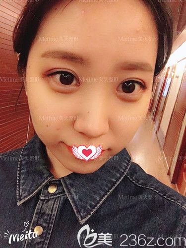 郭東超醫(yī)生為我做眼綜合術(shù)后1個(gè)月完全消腫 郭東超醫(yī)生為我做眼綜合術(shù)后1個(gè)月完全消腫