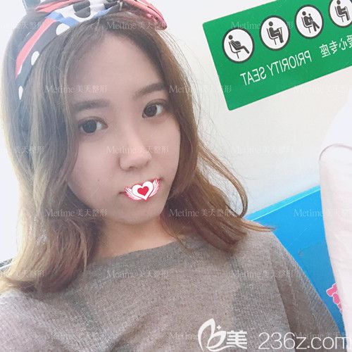 想知道眼綜合術(shù)后是否真實(shí)自然 可以參考下我在承德美天做的無痕全切雙眼皮+開眼角手術(shù)效果