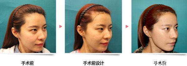 在韓國毛杰琳做了發(fā)際線移植后3個(gè)月