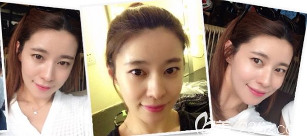 在韓國毛杰琳做了發(fā)際線移植9個月后不僅改善了我寬額頭臉也顯小了